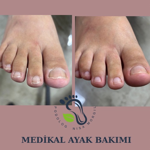 MEDİKAL AYAK BAKIMI